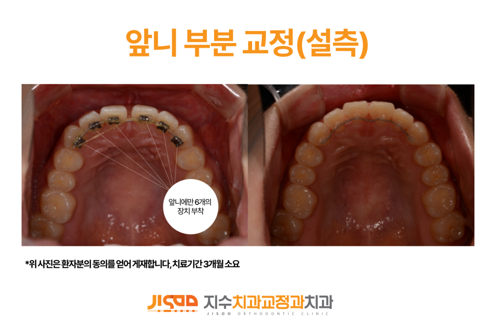 대구수성구교정치과 앞니부분교정 진단과 치료 사례