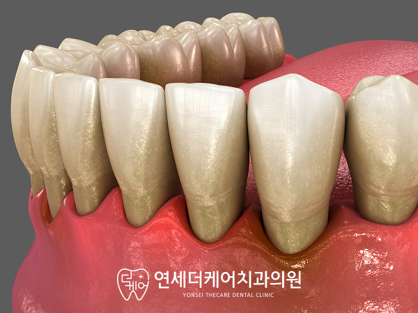 치주염에 의해 녹아내린 잇몸