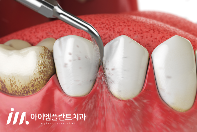 안산 치아미백 가격, 이벤트를 활용해도 괜찮을까? - 3
