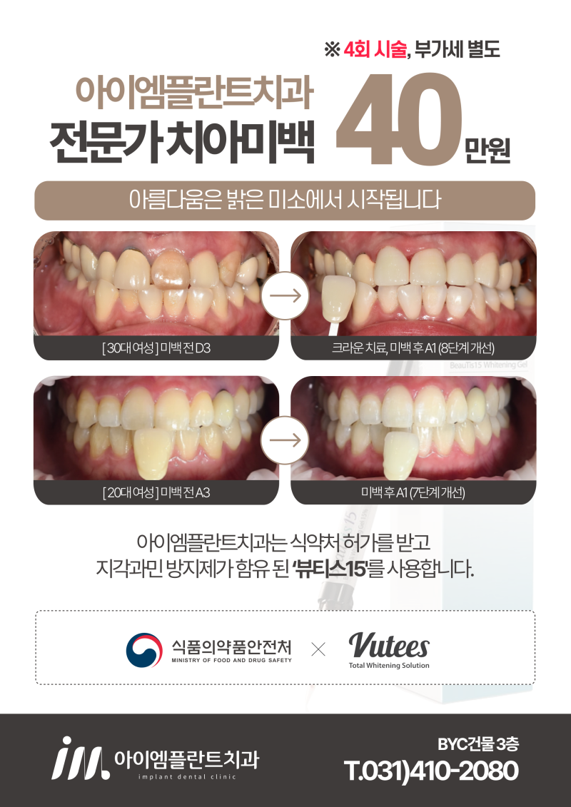 안산 치아미백 가격, 이벤트를 활용해도 괜찮을까? - 5