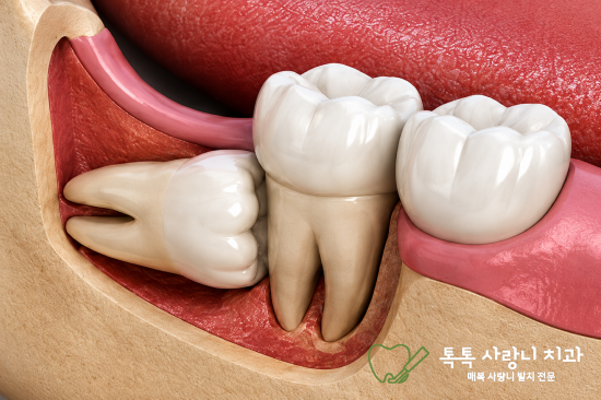 대구 달서구 사랑니, 사랑니 발치 후 감각이상이 걱정된다면 확인해 보세요 - 2