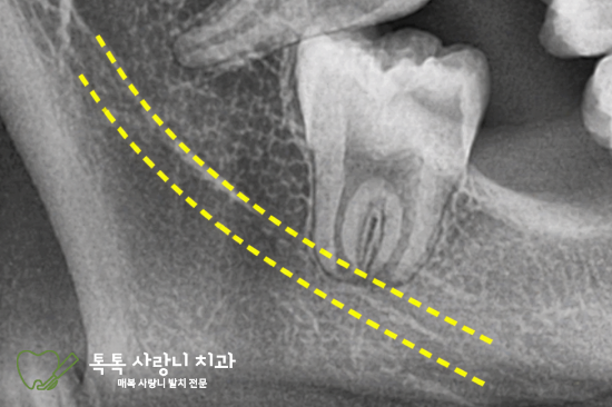대구 달서구 사랑니, 사랑니 발치 후 감각이상이 걱정된다면 확인해 보세요 - 3