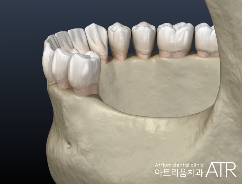 평택 임플란트 비용, 저렴한 곳을 찾아다니셨다면 이젠 잘하는 곳에서 합리적인 올온엑스(All on X)로 해보세요 - 3