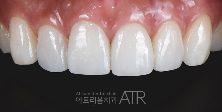 평택 잇몸미백, 검게 변색되는 잇몸의 원인과 치료방법은? - 5