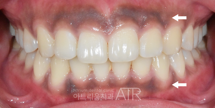 평택 잇몸미백, 검게 변색되는 잇몸의 원인과 치료방법은? - 1