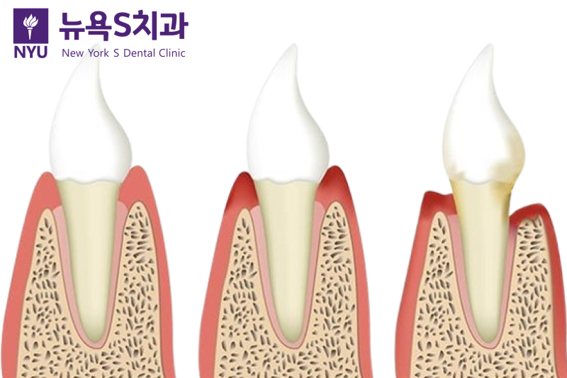 안국역 잇몸치료 치과, 치은염과 치주염, 중요한 것은 현재 상태입니다 - 1