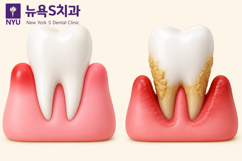 안국역 잇몸치료 치과, 치은염과 치주염, 중요한 것은 현재 상태입니다 - 2