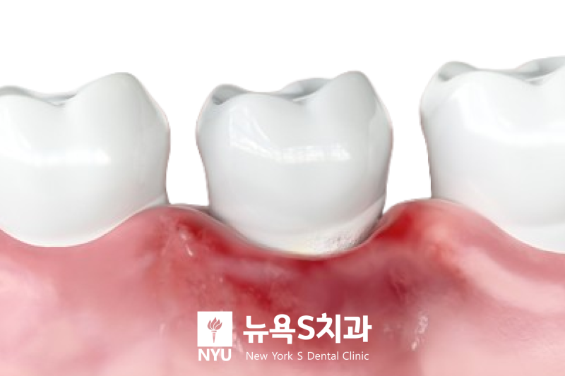 안국역 잇몸치료 치과, 치은염과 치주염, 중요한 것은 현재 상태입니다 - 3