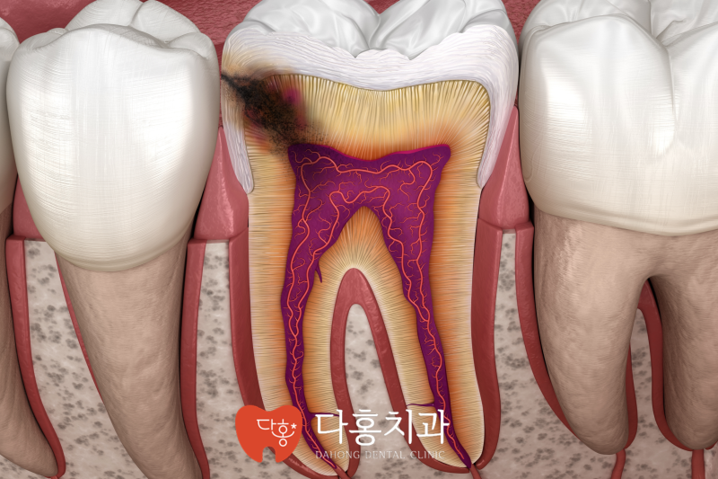 천호동 충치치료 치과, 큐레이 진단으로 정확한 치료 가능할까요? - 1