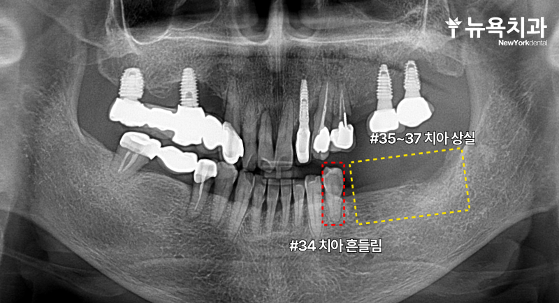 구월동 임플란트 재수술, 다른 치과에서 했던 임플란트 주변 출혈로 내원하신 환자분의 재수술 및 추가 수술 증례 - 2
