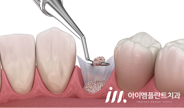 안산 당일 임플란트, 가능한 경우와 기다려야 하는 경우의 차이 - 3