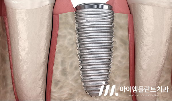 안산 당일 임플란트, 가능한 경우와 기다려야 하는 경우의 차이 - 4