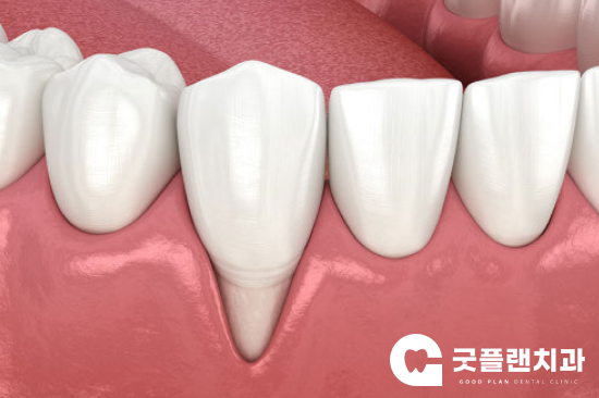 대구 칠곡치과, 양치할 때 소스라치게 시리다면? - 1