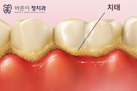 노원스케일링, 정기적으로 받아야 하는 이유는 무엇일까? - 1