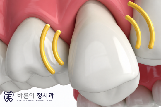 노원스케일링, 정기적으로 받아야 하는 이유는 무엇일까? - 3