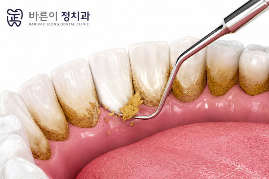 노원스케일링, 정기적으로 받아야 하는 이유는 무엇일까? - 5
