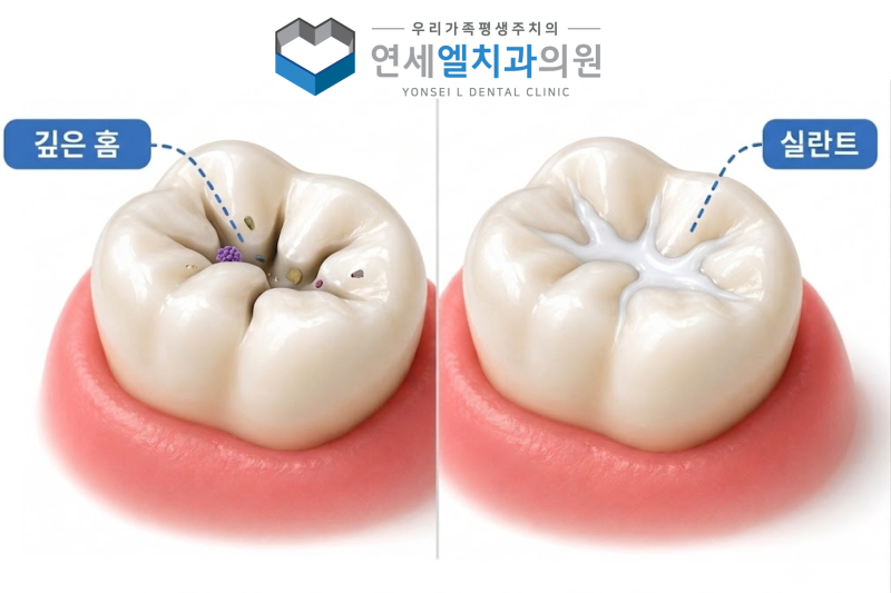 행신동어린이치과, 어린이 실란트 홈메우기, 꼭 필요한 치료일까요? - 1