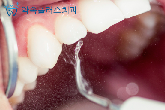 힐스테이트 지제역 치과, 스케일링 1년에 한 번이면 충분할까요? - 1