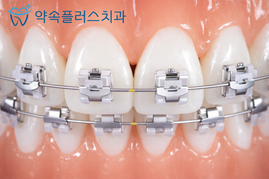 힐스테이트 지제역 치과, 스케일링 1년에 한 번이면 충분할까요? - 3