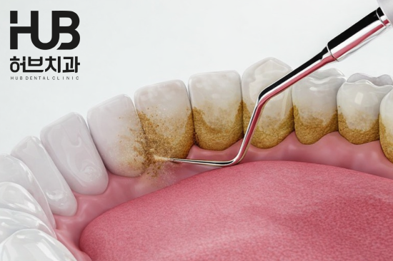 온천동 잇몸치료, 잇몸 주머니 mm의 비밀, 내게 진짜 필요한 잇몸 치료는? - 3