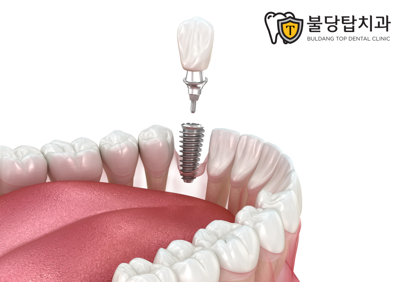 천안 임플란트 뼈이식, 모든 분들에게 필요한 것은 아닙니다 - 2
