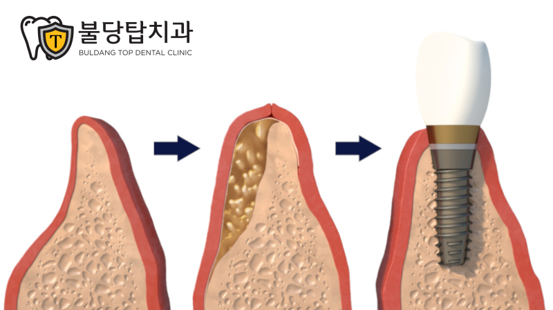 천안 임플란트 뼈이식, 모든 분들에게 필요한 것은 아닙니다 - 1