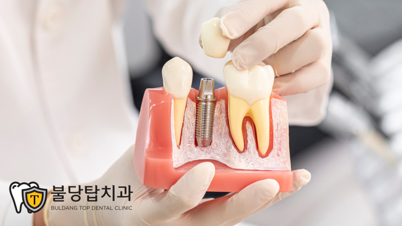 천안 임플란트 뼈이식, 모든 분들에게 필요한 것은 아닙니다 - 4
