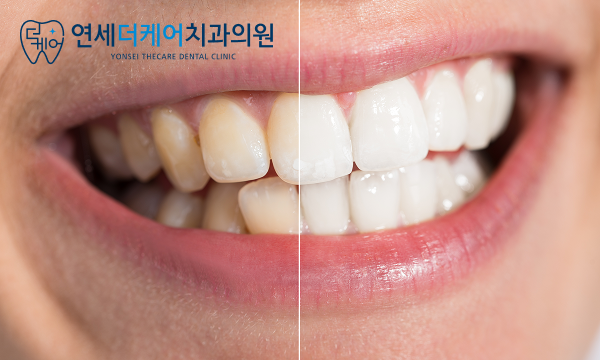 세종 치아미백, 시중 미백제와 치과에서 하는 것 효과는 어떻게 다를까요? - 4