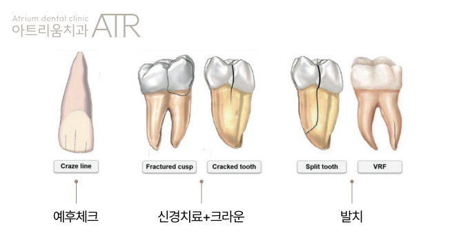 평택 치아 실금, 유독 씹을 때만 아프다면? 크랙 가능성이 있습니다 - 3