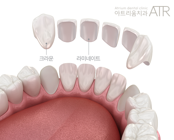 평택 치아 벌어짐, 라미네이트와 크라운 중 고민되신다면? - 2
