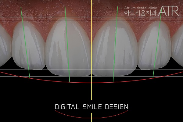 평택 치아 벌어짐, 라미네이트와 크라운 중 고민되신다면? - 4