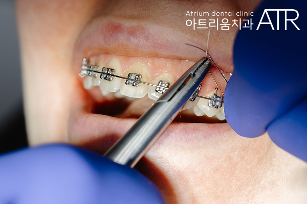평택 투명교정, 미리 장치 교정했던 사람들이 후회하는 대표적인 이유 - 4