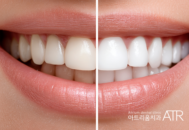 비전동 치아미백 치과, 아트리움치과가 하루에 여러 번 시술하지 않는 이유 - 1