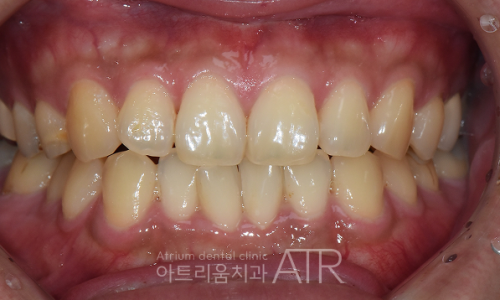 비전동 치아미백 치과, 아트리움치과가 하루에 여러 번 시술하지 않는 이유 - 3