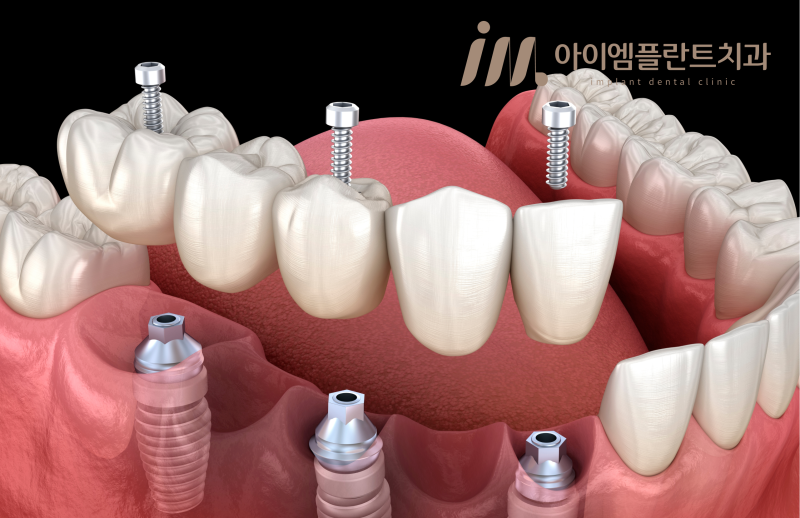 안산 어르신 임플란트, 다수 치아 상실이 걱정될 땐 최소절개 디지털 수술로 - 1
