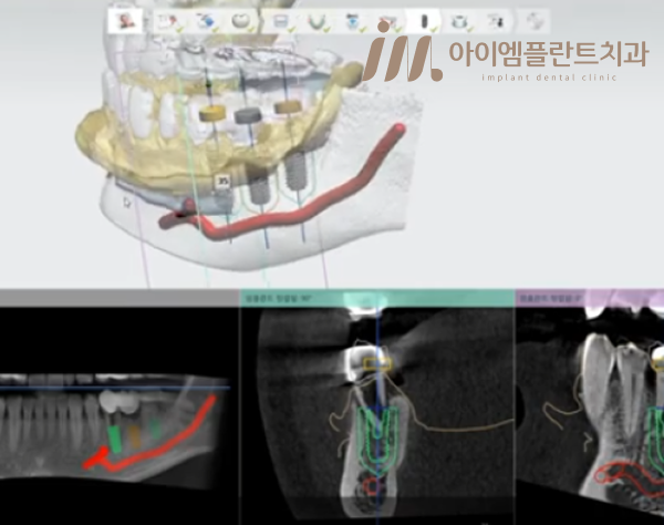 안산 어르신 임플란트, 다수 치아 상실이 걱정될 땐 최소절개 디지털 수술로 - 2