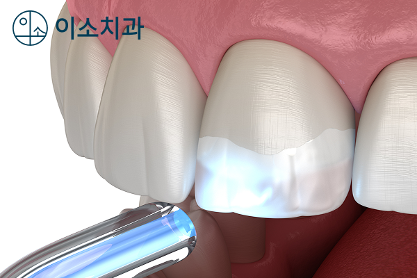 오산 앞니 충치, 깨지고 손상된 앞니를 레진으로 당일 치료 - 2