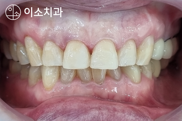 오산 앞니 충치, 깨지고 손상된 앞니를 레진으로 당일 치료 - 4