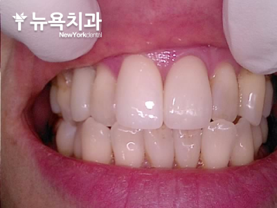 반대편 앞니의 길이와 형태를 고려해 제작한 지르코니아 크라운
