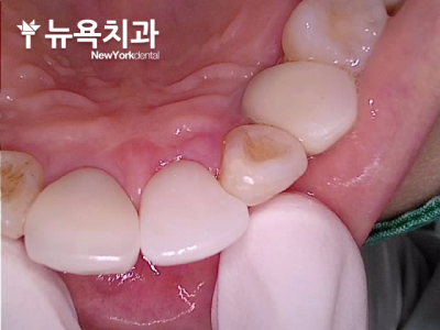자연치아의 색조와 빛 투과율을 고려한 앞니 지르코니아 크라운