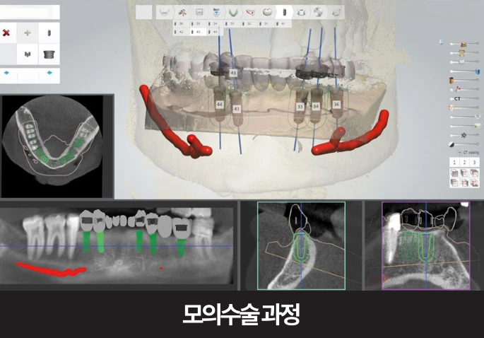 천안네비게이션임플란트, 임플란트 수술이 아플까 봐 걱정된다면