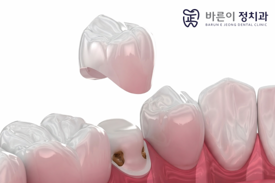 중계동충치치료, 크라운, 인레이 등 보철 치료 후 충치 재발이 생기는 이유