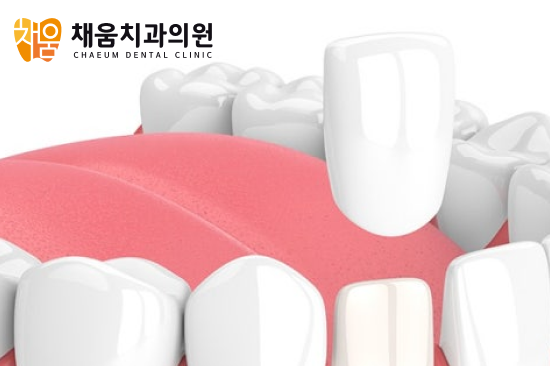 면목역치과, 앞니 올세라믹과 라미네이트 차이는?