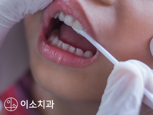 오산 어린이 치과 불소도포 충치 예방