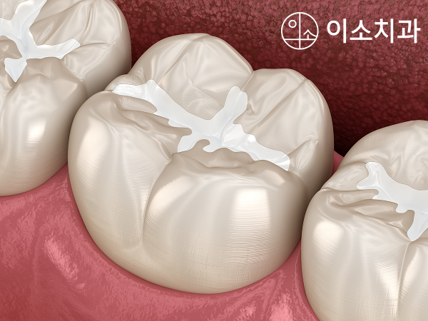 오산 어린이 치과, 충치 예방의 핵심은 홈메우기와 불소도포입니다