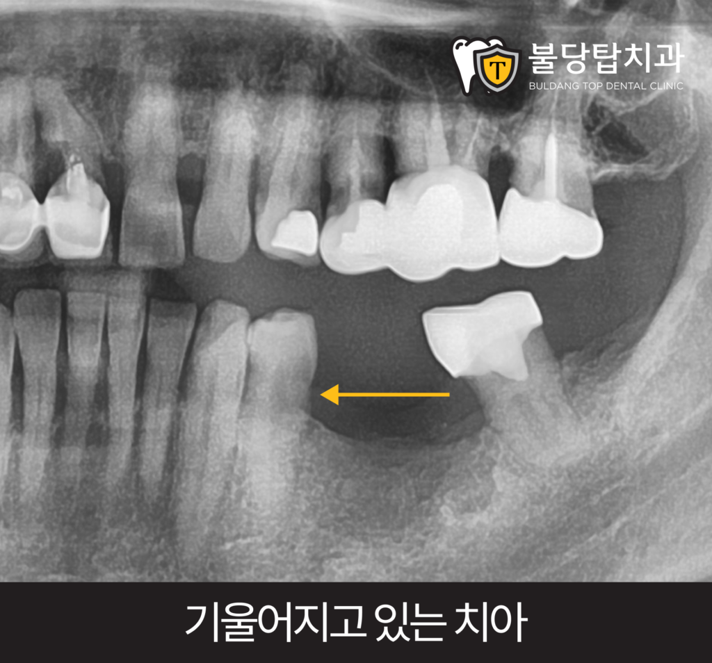 천안어금니빠짐, 그냥 방치하시면 안됩니다