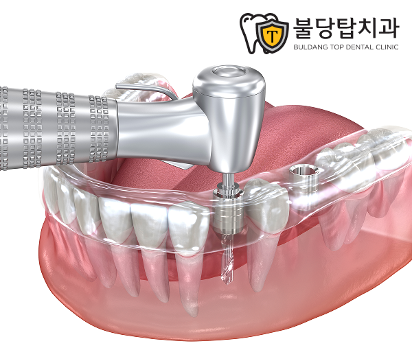 천안 임플란트 안아프게 하는곳은 통증을 이렇게 줄입니다