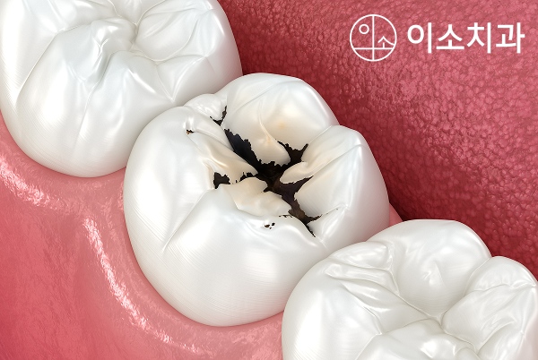 오산 어린이 치과, 충치를 예방하는 가장 중요한 두 가지는 홈메우기와 불소도포입니다.