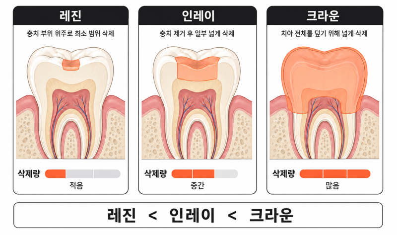 천안 충치치료 잘하는 치과에서 가장 먼저 신경 쓰는 자연치아 삭제량 - 1