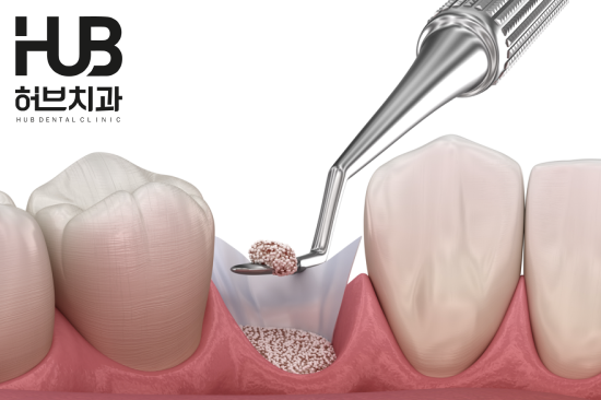 용화동 임플란트 치과, 수술보다 중요한 '이 과정' 알고 계시나요? - 2